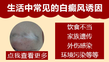 白癜风症状有那些
